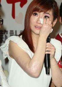 哪个明星被火烧伤,当红明星遭遇意外火灾,全身烧伤令人痛心